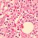 Fig. 1B: Higher magnification of Fig. 1A showing infiltration by eosinophils displaying orangeophilic cytoplasm and bilobed nucleus. (x 100 magnification; Haematoxylin & Eosin stain).